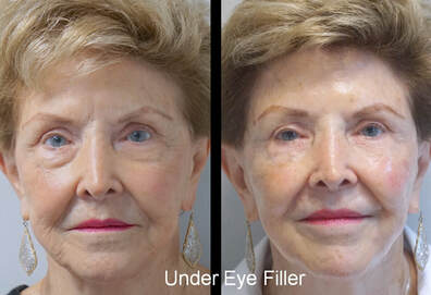 Under Eye filler Before and After
