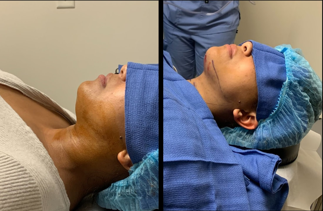 Neck Liposuction in Tampa Before and After