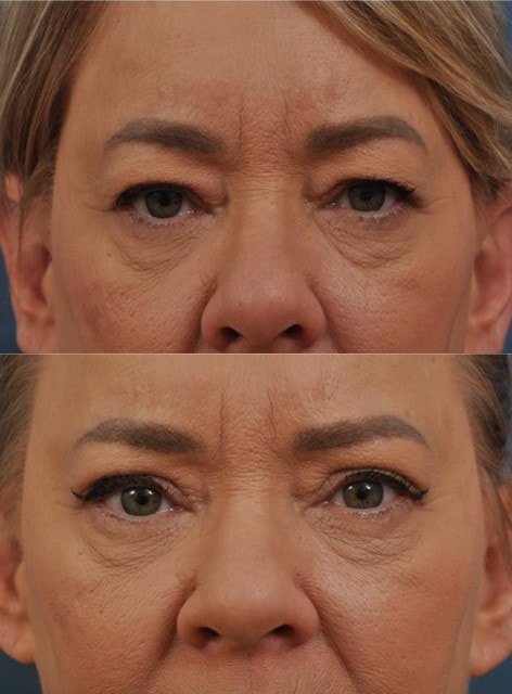 Upper eyelid lift before and after
