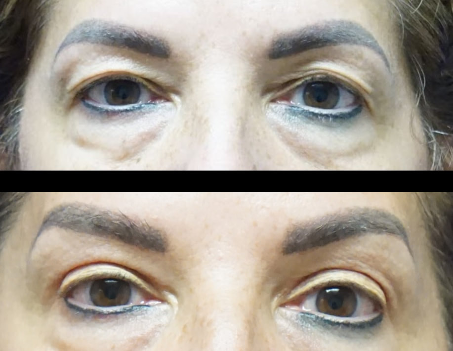 Upper Eyelid surgery or blepharoplasty in Tampa before and after